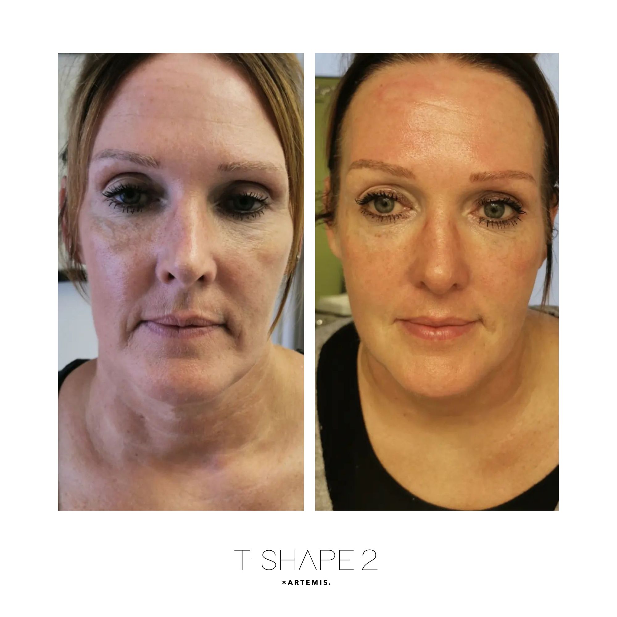 Face before and after T-Shape 2 results — After 4 treatments